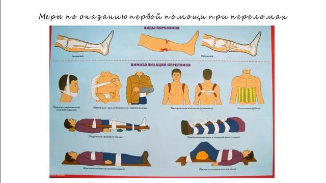 Первая помощь при переломах