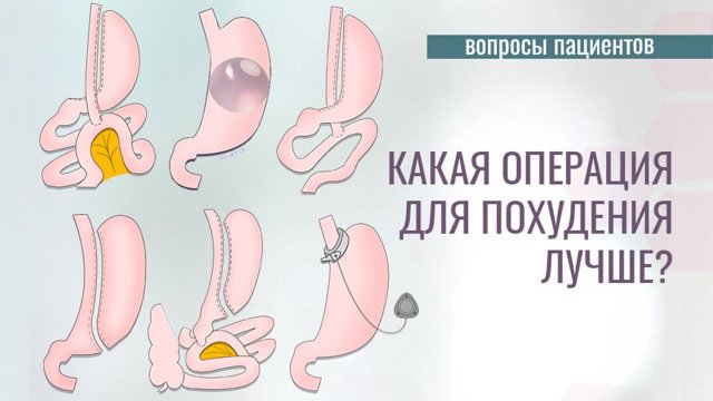 Какая бариатрическая операция самая лучшая?