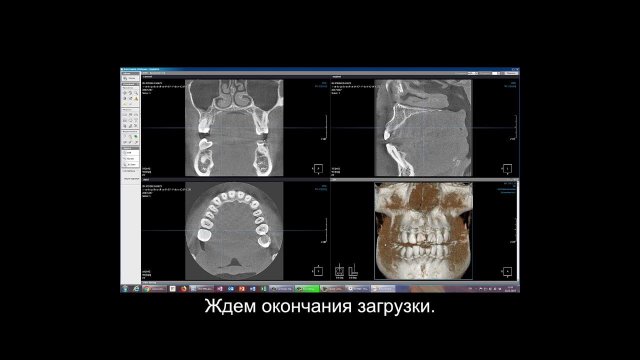 установка Xelis Dental для просмотра КТ