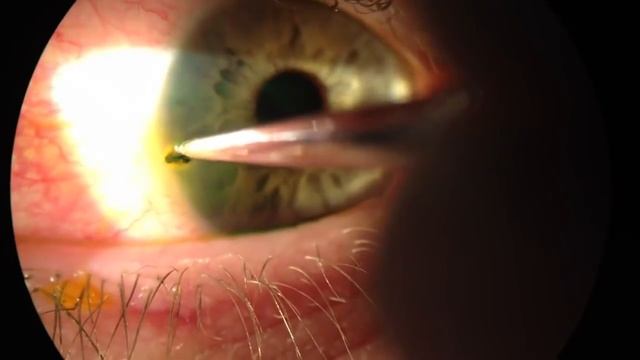 Процесс удаления окалины из глаза