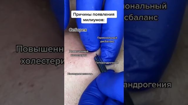 Удаление черных точек Большие кистозные прыщи Удаление черных точек Удаление прыщей