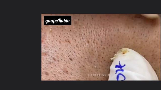 черные точки ,удаление черных точек на лице