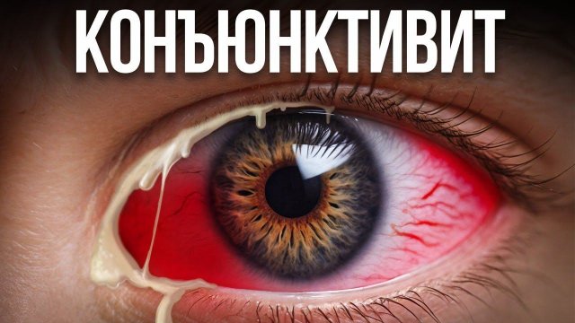Красные глаза, конъюнктивит лечение! Как вылечить КОНЪЮКТИВИТ за 1 день без медикаментов?