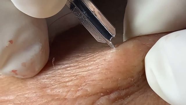 Acne Treatment Huong Da Nang# 064 |  Loyal fans
