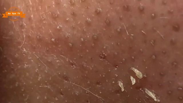 #05 Best Nose Plucking Blackheads Whiteheads Removal | Acne Treatment