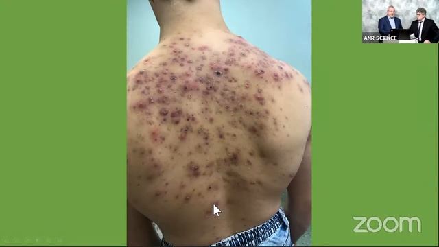Акне. Современные принципы лечения