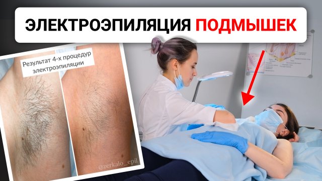 Урок №47. Техника проведения электроэпиляции подмышек. Как правильно делать электроэпиляцию?