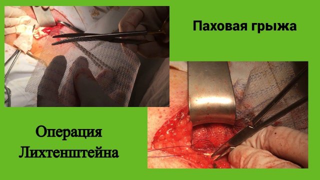 Паховая грыжа  Операция Лихтенштейна