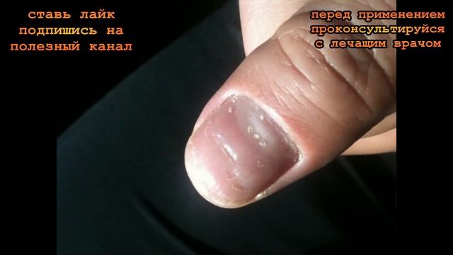★Как избавиться от ГРИБКА НОГТЕЙ пищевой содой, уксусом, медным купоросом. Зуд и запах пройдут.