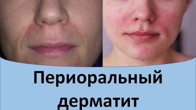 Периоральный дерматит.