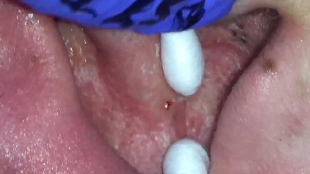 Ear Extractions on Draven