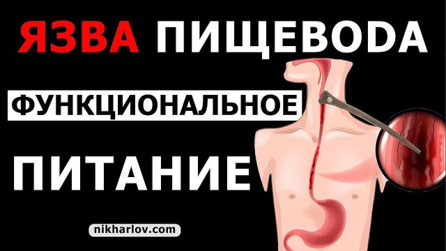 ? Рыбная кость повредила пищевод. Образовалась язва пищевода. Функциональное питание для заживления