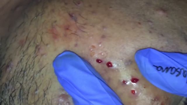 BEST ACNE TREATMENT with BLACKHEAD REMOVAL PART 2 BY POPPING KING DR.LALIT KASANA