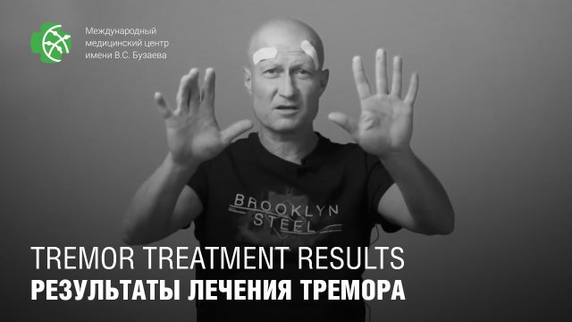 Результаты лечения тремора методом МР-ФУЗ в ММЦ им. В.С. Бузаева.. Пациент М., Украина.