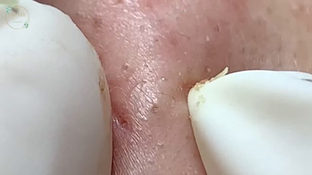 Treatment Of Blackheads And Hidden Acne #057