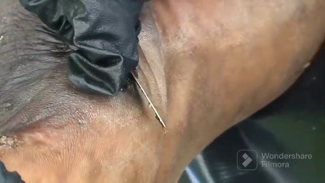 Worst Jigger infestation ever