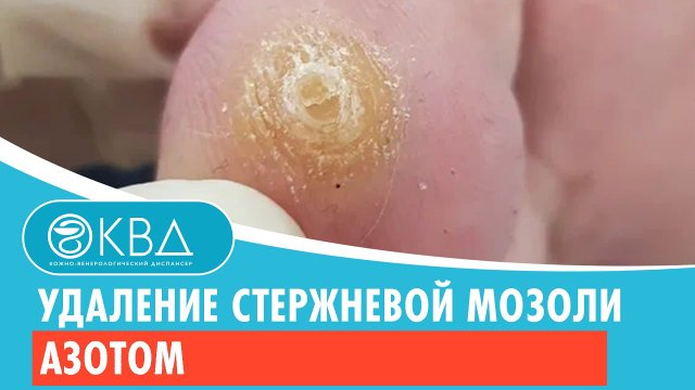 ? Удаление стержневой мозоли азотом. Клинический случай №392