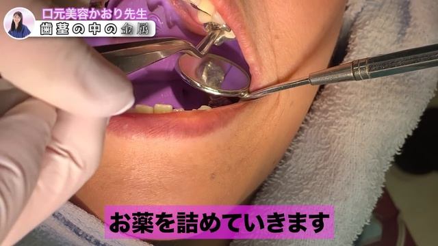 歯ではない謎の物体...歯ぐきに埋まった金属どけたら白いかたまり出てきた　歯医者驚天動地