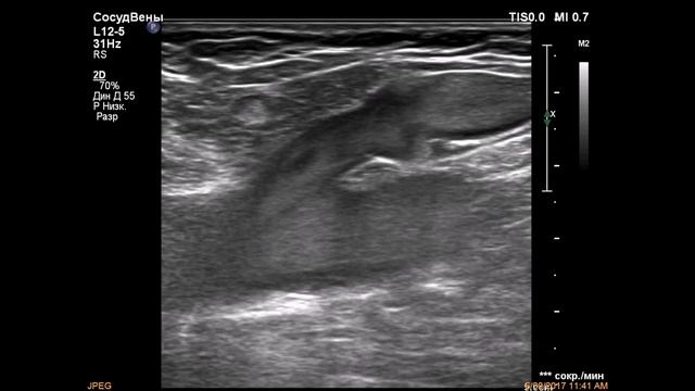 Недостаточность клапанов большой подкожной вены