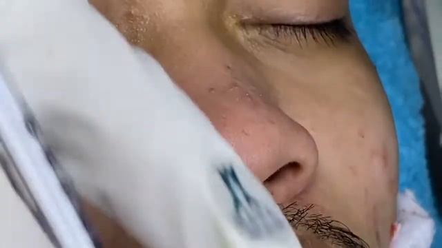 Relaxing Acne Treatment Acnes Treatment 128