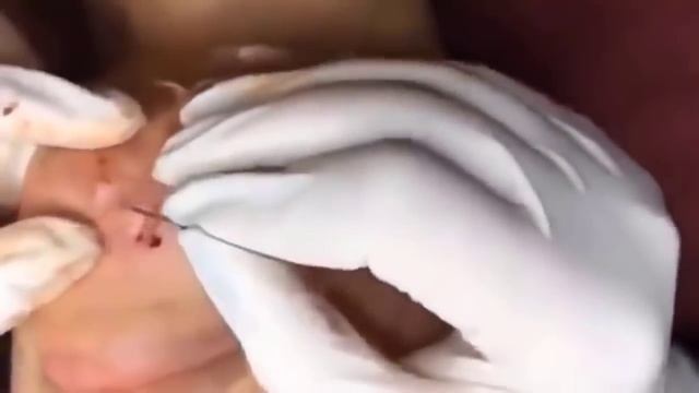 BESTПРЫЩ КОВЫРЯЕМ ЖИРНЫЕ ПРЫЩИ И ЧЕРНЫЕ ТОЧКИ