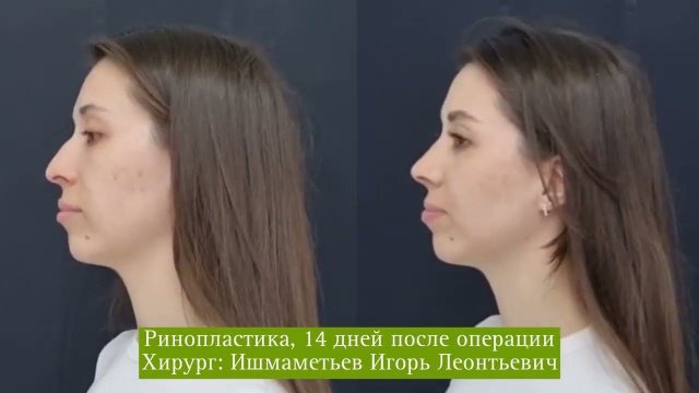 Ринопластика. Ишмаметьев Игорь Леонтьевич. Лада Эстет Ижевск