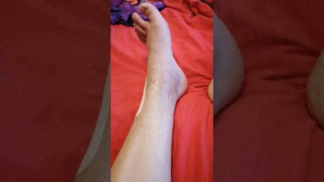 Удаление позиционного винта при переломе голеностопа