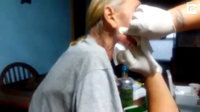 ВЫДАВЛИВАНИЕ ОГРОМНОГО ЧИРИЯ НА ЛИЦЕ У СТАРИКА!!!! 18+