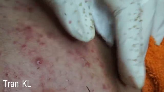 Acne Blackheads Whiteheads removals on face | How to get rid of blackheads easy part 7