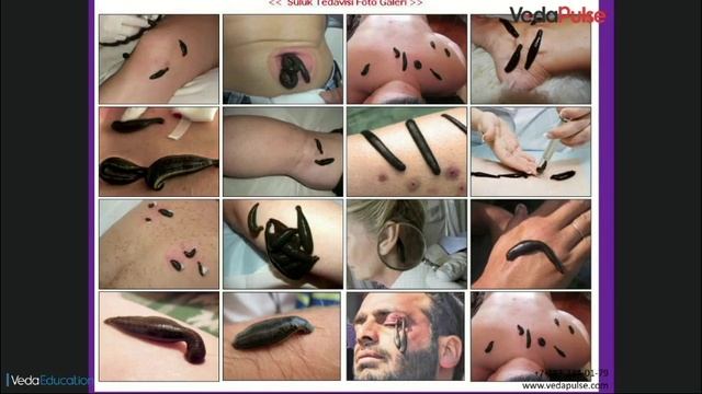 Лечение пиявками: за и против. Опыт применения гирудотерапии от практикующего врача