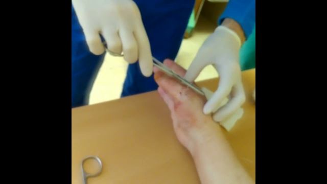 Перелом! Как мне снимали спицы! НЕ БОЛЬНО!