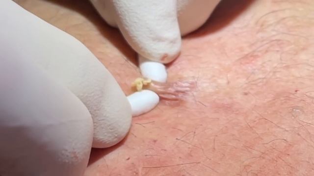 Steatocystoma Multiplex. Dozens of extractions on the chest. Chronic condition. MrPopZit.