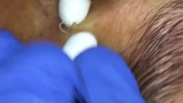 Blackheads Extractions Justin 1st Treatment