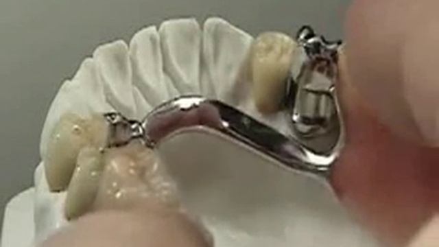 Частичный съемный протез - его изготовление и установка