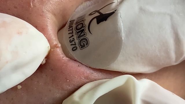 Make your Acne Treatment Huong Da Nang | 423 # acne 2022