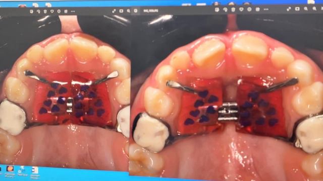 Что такое аппарат Хааса. Рассказывает стоматолог-ортодонт Зубаирова А. В.