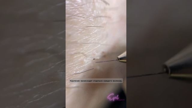 Процесс электроэпиляции. #эпиляция #epil #электроэпиляция