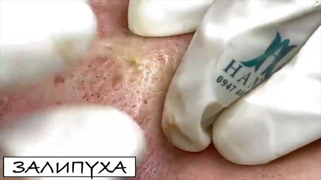 ПРЫЩИ 😍 ПРЫЩИ ВЫДАВЛИВАНИЕ 😍 ПОДБОРКА ВЫДАВЛИВАНИЕ ПРЫЩЕЙ #прыщи #acne #asmr #прыщиналице