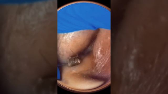 Акне. Черные точки. Вросшие волосы и прыщи. Ушная пробка и сера!