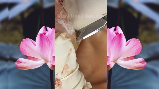 Выдавливание чёрных точек НОВОЕ! Удаление чёрных точек за ухом. p17