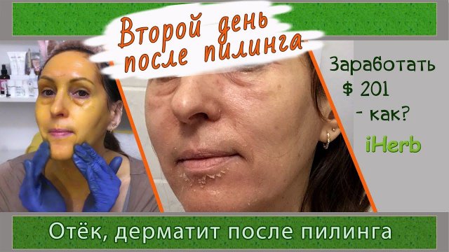 После пилинга ретинолового - второй день