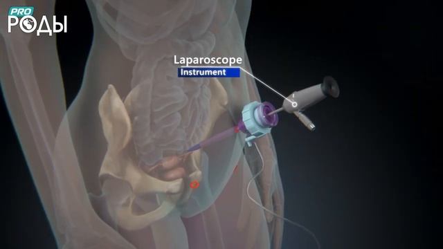 Диагностическая лапароскопия органов малого таза
