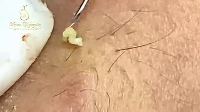 Relax squeezing out blackheads #9 Черные точки