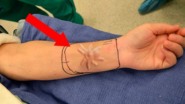 СУЩЕСТВА, НАЙДЕННЫЕ ЖИВЫМИ ВНУТРИ ЧЕЛОВЕЧЕСКОГО ТЕЛА