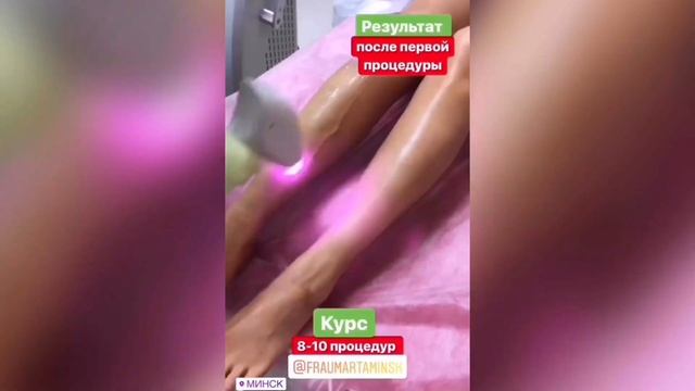 До -70% на лазерную эпиляцию в Фрау Марта