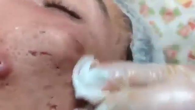 НОВОЕ ВИДЕО 2022 Прыщи давить залипательные