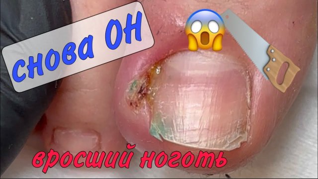 ⚡️⛔️вросший ноготь_ 😭воспалился палец_ боль в пальце