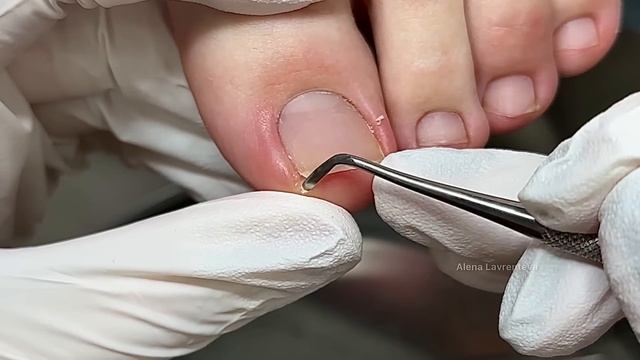 Ноготь - скрепка / Вросший ноготь / Врос на ноге / Что делать / Вросший ноготь на ноге