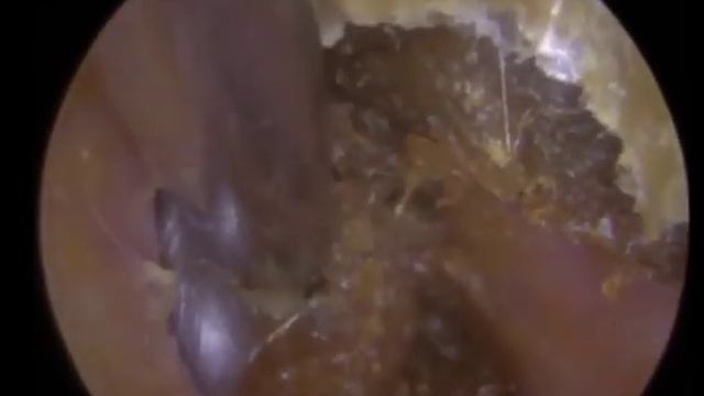 Извлечение огромного куска ушной серы из уха | Часть 3