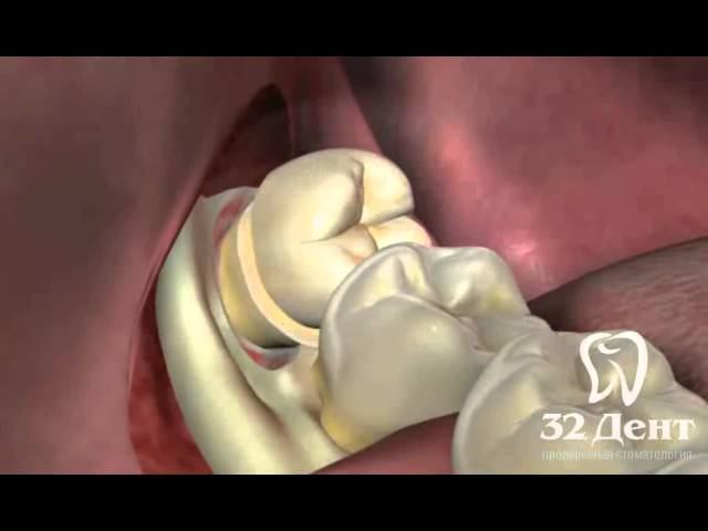 Удаление зуба мудрости